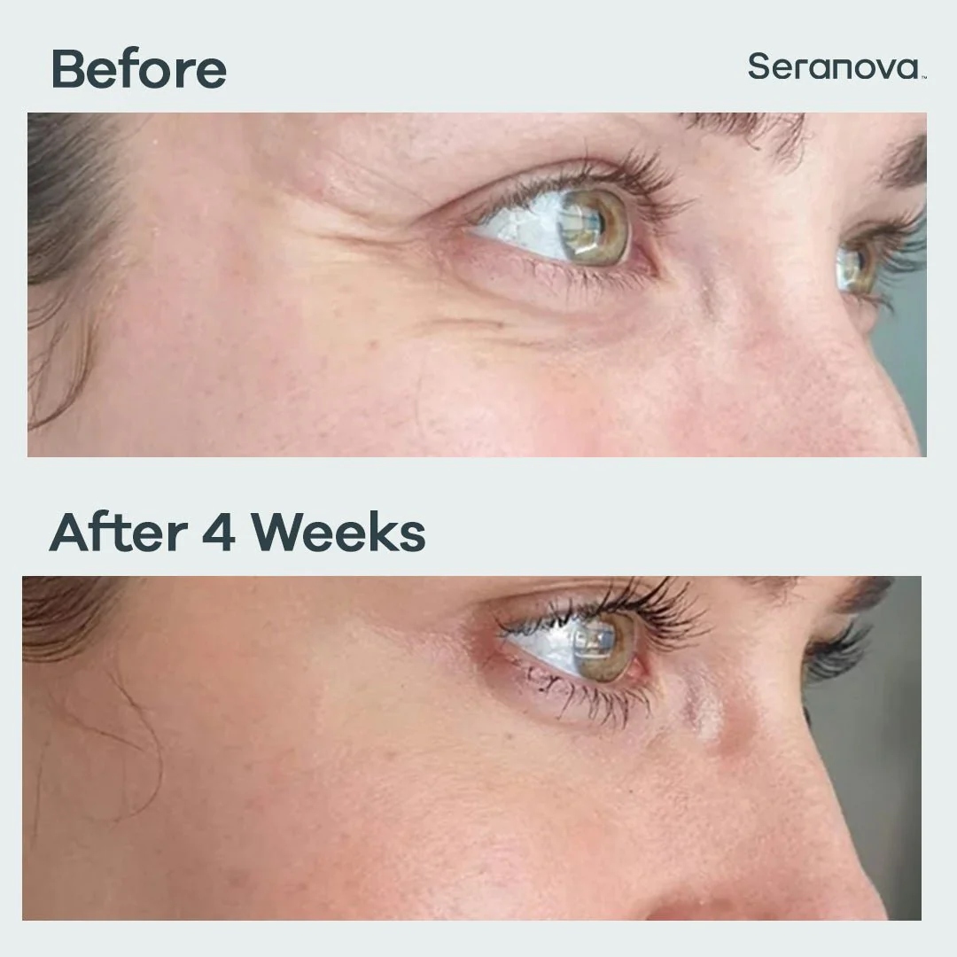 3 Month Supply - Micro Infusion Patches - Image 5